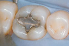 Dental Fillings Phuket