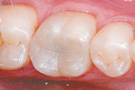 Phuket Dental Fillings