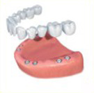 Dental Implant Bridge