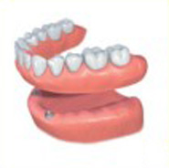 Phuket Denture Implants