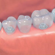 Dental Implant Bridge